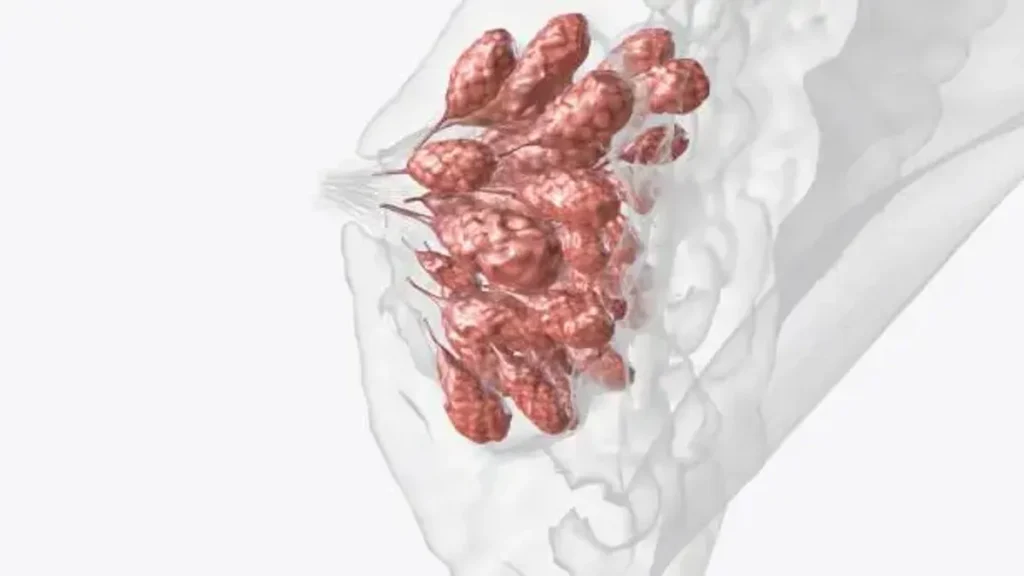 Fibroadenoma: Understanding the Benign Breast Lump