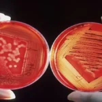 Botulizmi (Botulism) Explained: Causes, Symptoms, Types, Treatment, and Why This Rare Toxin Remains Deadly